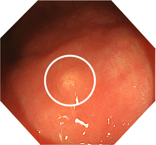 院長が診断した早期大腸がんの代表例