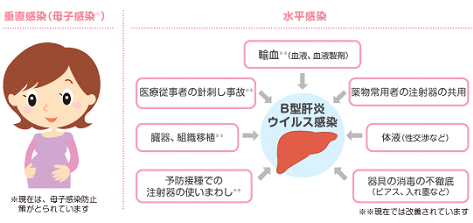 B型肝炎