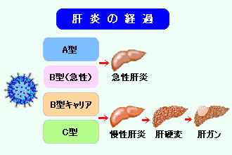 肝炎の経過