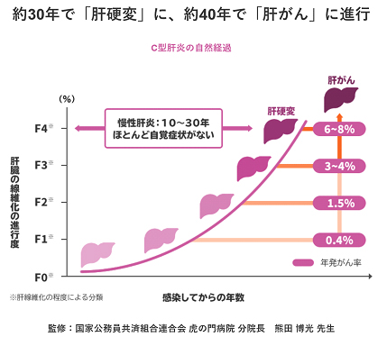 約30年で「肝硬変」に、約40年で「肝がん」に進行