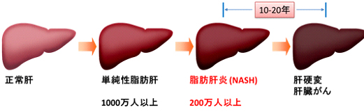 脂肪肝・脂肪肝炎