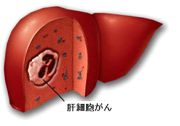 肝臓がん