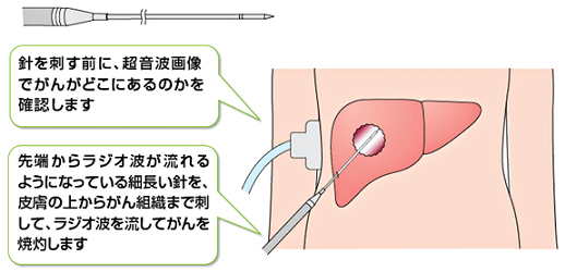 肝臓がん