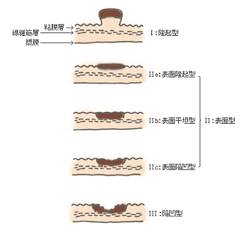 なぜ胆のうがんの早期診断は難しいか？