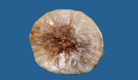 コレステロール胆石