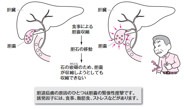 胆石発作の起こり方