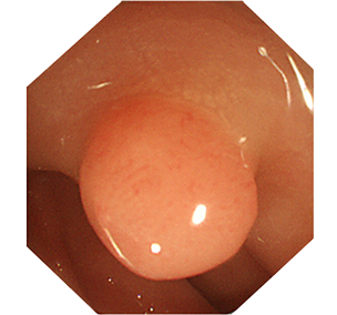 院長が診断した早期大腸がんの代表例