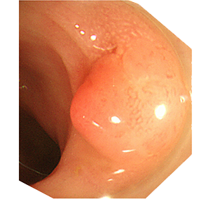 院長が診断した早期大腸がんの代表例